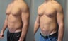 Gynecomastia New York