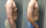 Gynecomastia