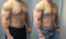 Gynecomastia surgery