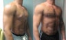 Gynecomastia