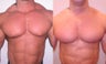 Gynecomastia