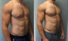 Gynecomastia