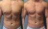 Gynecomastia