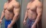 Gynecomastia