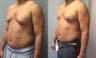 gynecomastia