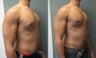 Gynecomastia