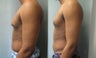 Gynecomastia
