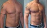 Gynecomastia
