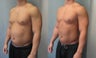 Gynecomastia