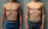 Gynecomastia