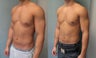 Gynecomastia