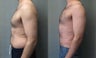 Gynecomastia, Lipo of abs and waists