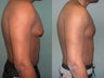 Gynecomastia