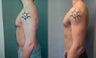 Gynecomastia
