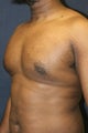 Gynecomastia