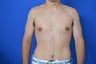 Gynecomastia - Male Breast Reduction