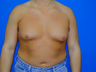 Male Breast Reduction