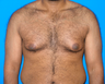 Male Breast Reduction