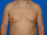 Male Breast Reduction