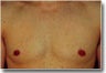 Male Breast Reduction/Gynecomastia