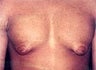 Male Breast Reduction/Gynecomastia