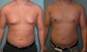 Gynecomastia Surgery