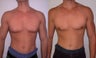 Gynecomastia