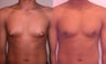 Gynecomastia