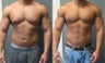 Gynecomastia Surgery