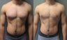Gynecomastia