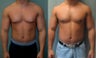 Gynecomastia New York