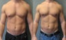 Gynecomastia New York