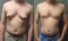 Gynecomastia