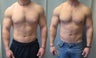 Gynecomastia surgery