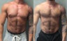 Gynecomastia