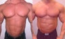 Gynecomastia