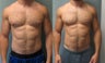 Gynecomastia