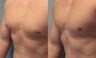 Gynecomastia