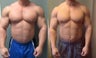 Gynecomastia