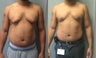 gynecomastia