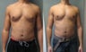Gynecomastia