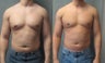 Gynecomastia
