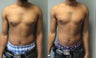 Gynecomastia