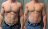 Gynecomastia