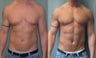 Gynecomastia