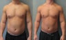 Gynecomastia