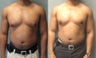 Male Breast Reduction