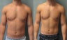 Gynecomastia