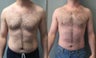 Gynecomastia, Lipo of abs and waists