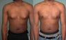 Gynecomastia